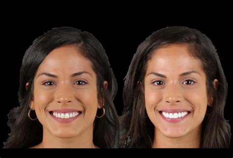 nany gonzalez teeth|Nany Gonzalez Before And After Veneers Transformation Is